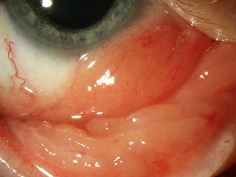 גידול בעין, לימפומה של הלחמית (conjunctival lymphoma) - פרופ' עידו דידי פביאן, אונקולוג עיניים