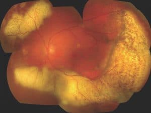 לימפומה תוך עינית (intraocular lymphoma)​ - פרופ' עידו דידי פביאן, אונקולוג עיניים