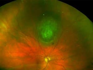 נקודת חן תוך עינית (intraocular nevus) - פרופ' עידו דידי פביאן, אונקולוג עיניים