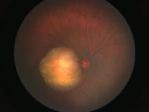 רטינובלסטומה (retinoblastoma)​ - פרופ' עידו דידי פביאן, אונקולוג עיניים