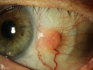 קרצינומה של הלחמית (squamous conjunctival intraepithelial neoplasia)​ - פרופ' עידו דידי פביאן, אונקולוג עיניים
