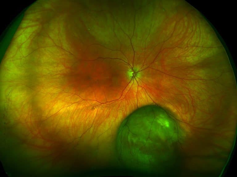 מלנומה של הענביה (uveal melanoma) - פרופ' עידו דידי פביאן, אונקולוג עיניים