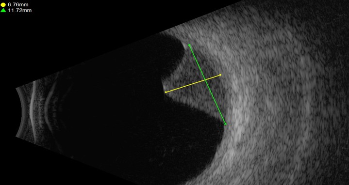 אולטרסאונד של מלנומה בתוך העין