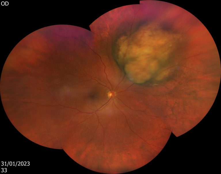 גידול בתוך העין - מלנומה