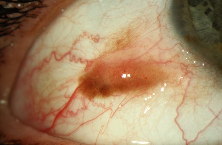 מלנומה בלחמית, אבחון מוקדם של גידולים בעין