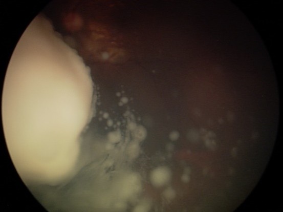 מתי העין מספרת על סרטן במקום אחר בגוף