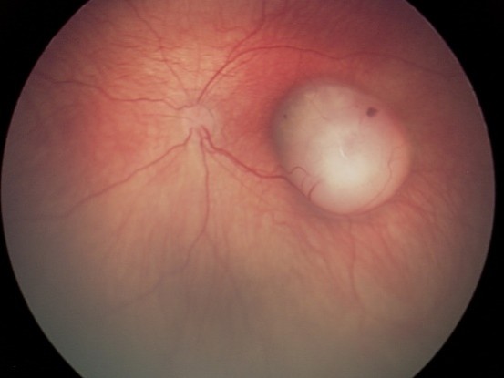 רטינובלסטומה בילדים