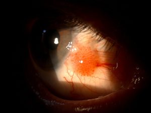 פלולה בעין או נקודת שומן: מתי זה קוסמטי ומתי גידול?